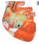 Καρδιογενές shock και υποάρδευση οργάνων