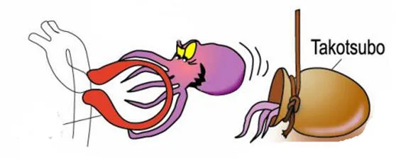 Ιαπωνικό δοχείο tako-tsubo που έδωσε το όνομα στο σύνδρομο