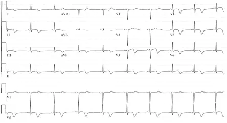 Ηλεκτροκαρδιογράφημα σε Takotsubo μυοκαρδιοπάθεια