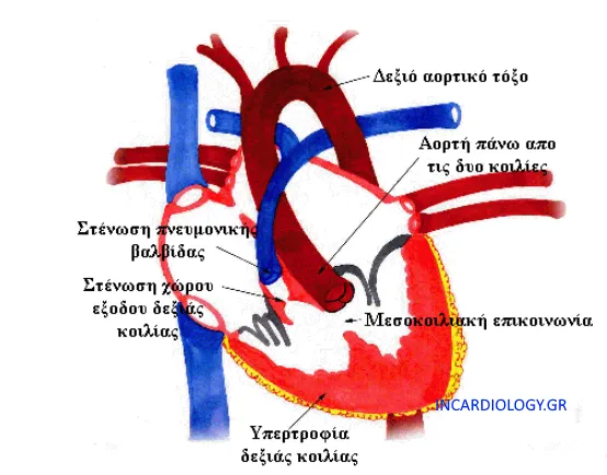 Ανατομικές αλλοιώσεις στην τετραλογία Fallot