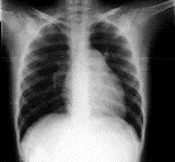 Ακτινογραφία θώρακα σε χρόνια πνευμονική υπέρταση