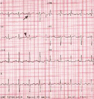 Σχηματική απεικόνιση πνευμονικής υπέρτασης και δεξιάς καρδιάς