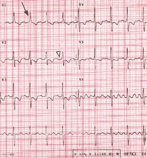Ηλεκτροκαρδιογράφημα με ευρήματα πνευμονικής υπέρτασης