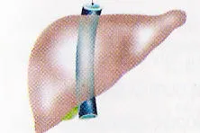 Διάταση ήπατος λόγω δεξιάς καρδιακής ανεπάρκειας