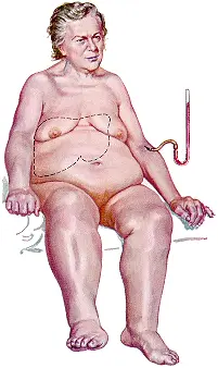 Οιδήματα κάτω άκρων και διάταση ήπατος σε καρδιακή ανεπάρκεια