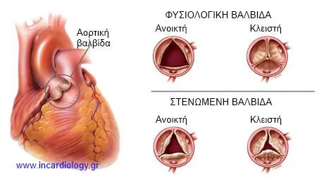Aortic Stenosis Anatomy