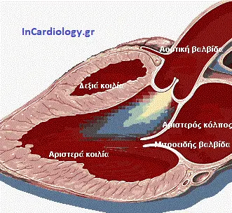 Aortic Regurgitation Diagram