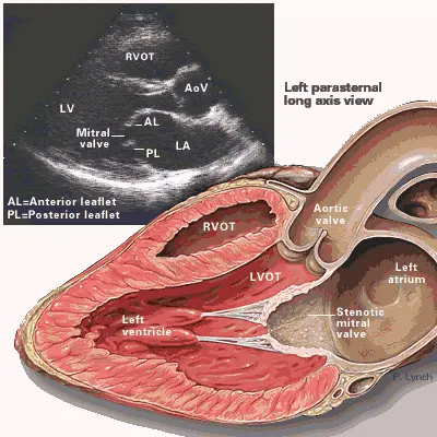 Mitral Valve Diagram