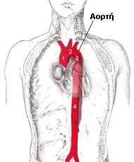 Aortic Dissection Diagram