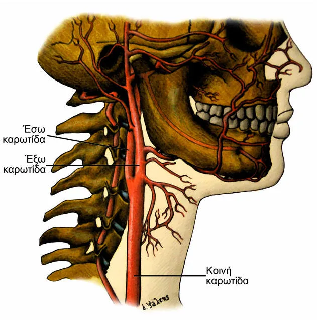 Carotid Stenosis Mechanism